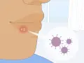 Un primo piano mostra un labbro con un'eruzione cutanea rossa e vesciche, con un ingrandimento che rivela virus. Utile per capire i rimedi per herpes labiale.