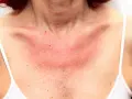 Collo e petto arrossati per eritema solare. Forse i rimedi della nonna possono aiutare a lenire la pelle irritata.