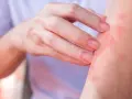 Dito, un braccio con eruzione cutanea rossa e pruriginosa, sintomo di un'allergia al nichel.