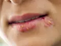 Labbra con vescicole e croste giallastre, tipiche di un herpes labiale. La durata varia, ma spesso si risolve in 1-2 settimane.
