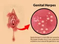 Illustrazione di herpes vaginale con lesioni e ingrandimento del virus.
