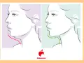 Profilo di donna con doppio mento prima (linea rossa) e dopo (linea verde) un trattamento.