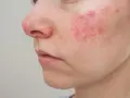 Primo piano del viso con arrossamenti e pustole, possibili effetti collaterali del collagene.