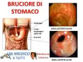 Illustrazione anatomica dello stomaco e immagini endoscopiche di gastrite e antrite acuta, condizioni che causano pirosi gastrica.