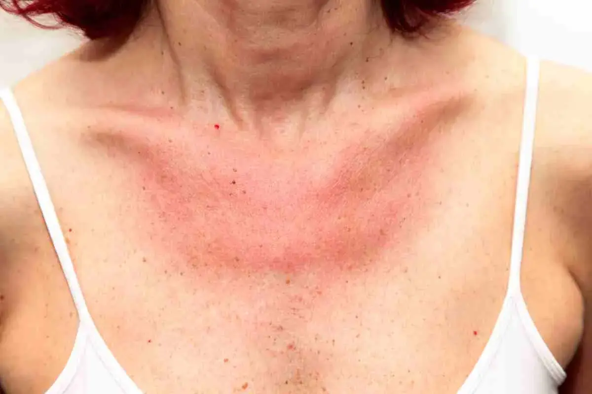 Collo e petto arrossati per eritema solare. Forse i rimedi della nonna possono aiutare a lenire la pelle irritata.