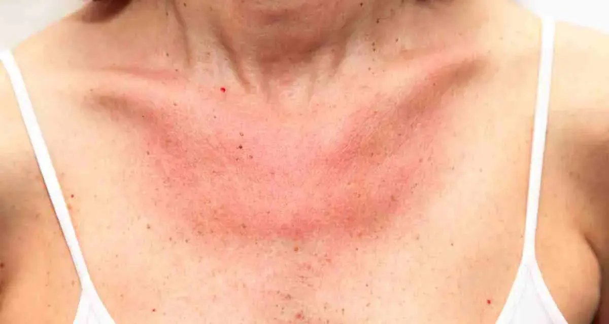 Collo e petto arrossati per eritema solare. Forse i rimedi della nonna possono aiutare a lenire la pelle irritata.