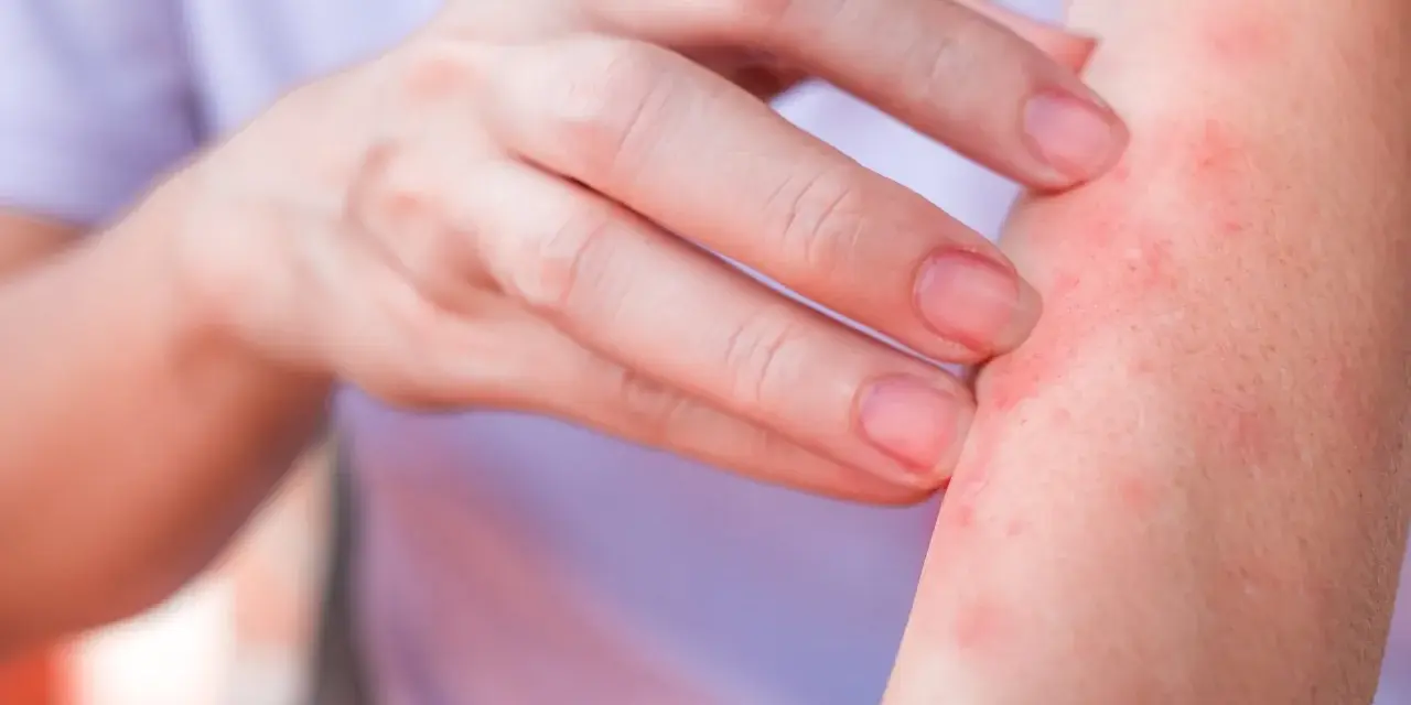Dito, un braccio con eruzione cutanea rossa e pruriginosa, sintomo di un'allergia al nichel.