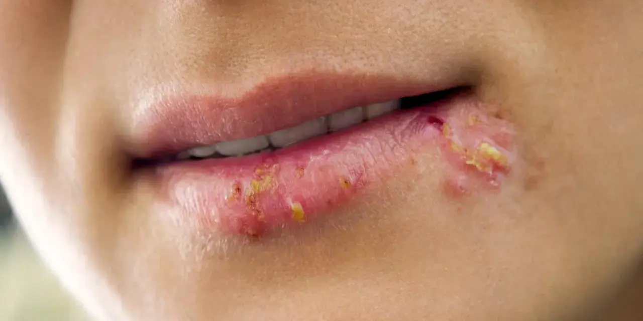 Labbra con vescicole e croste giallastre, tipiche di un herpes labiale. La durata varia, ma spesso si risolve in 1-2 settimane.