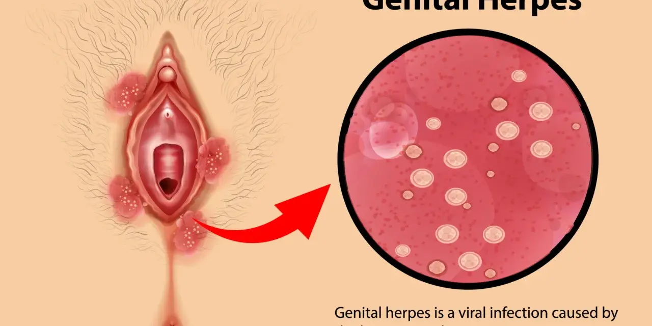 Illustrazione di herpes vaginale con lesioni e ingrandimento del virus.