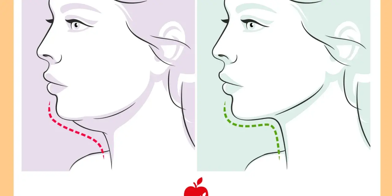 Profilo di donna con doppio mento prima (linea rossa) e dopo (linea verde) un trattamento.