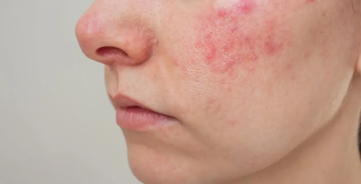 Primo piano del viso con arrossamenti e pustole, possibili effetti collaterali del collagene.