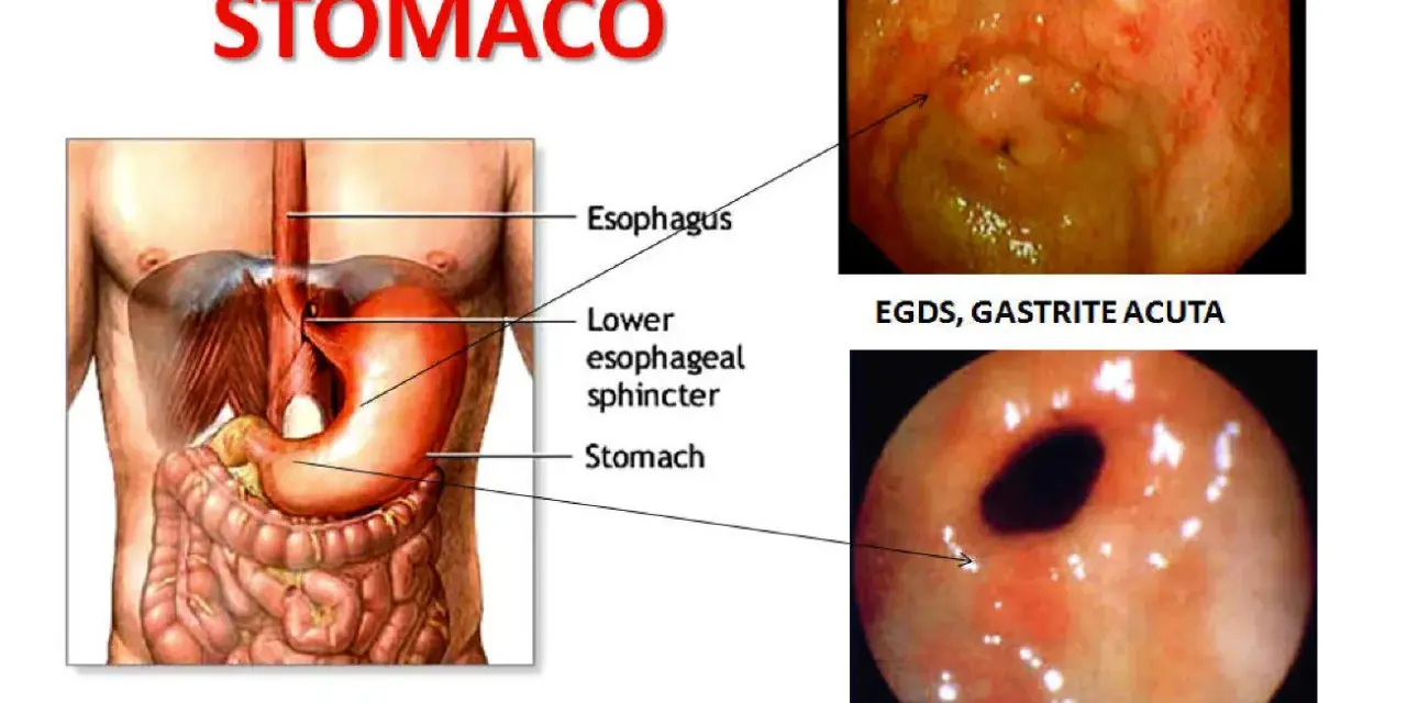 Illustrazione anatomica dello stomaco e immagini endoscopiche di gastrite e antrite acuta, condizioni che causano pirosi gastrica.