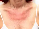 Collo e petto arrossati per eritema solare. Forse i rimedi della nonna possono aiutare a lenire la pelle irritata.