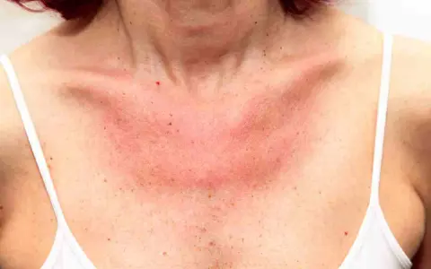 Collo e petto arrossati per eritema solare. Forse i rimedi della nonna possono aiutare a lenire la pelle irritata.