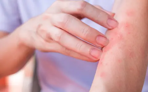 Dito, un braccio con eruzione cutanea rossa e pruriginosa, sintomo di un'allergia al nichel.