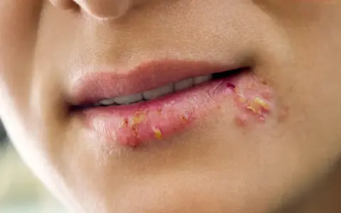 Labbra con vescicole e croste giallastre, tipiche di un herpes labiale. La durata varia, ma spesso si risolve in 1-2 settimane.