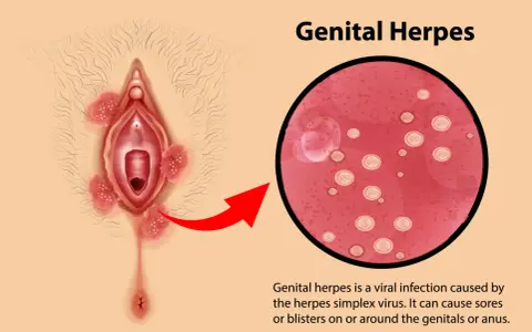 Illustrazione di herpes vaginale con lesioni e ingrandimento del virus.