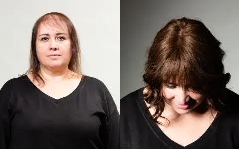 Prima e dopo: capelli diradati davanti, ora più folti e con un taglio che valorizza chi ha pochi capelli.