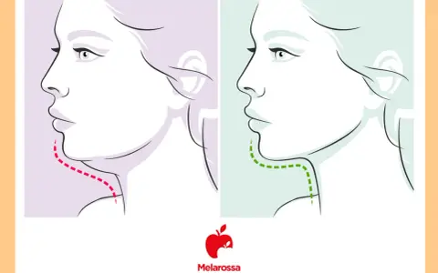 Profilo di donna con doppio mento prima (linea rossa) e dopo (linea verde) un trattamento.