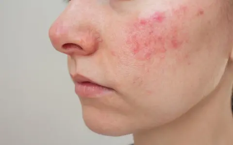 Primo piano del viso con arrossamenti e pustole, possibili effetti collaterali del collagene.