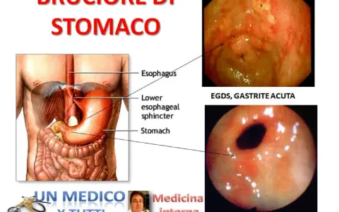Illustrazione anatomica dello stomaco e immagini endoscopiche di gastrite e antrite acuta, condizioni che causano pirosi gastrica.