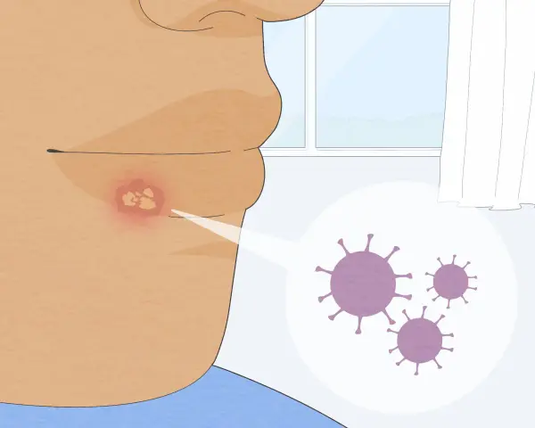Un primo piano mostra un labbro con un'eruzione cutanea rossa e vesciche, con un ingrandimento che rivela virus. Utile per capire i rimedi per herpes labiale.