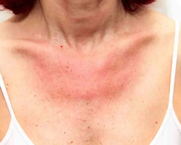 Collo e petto arrossati per eritema solare. Forse i rimedi della nonna possono aiutare a lenire la pelle irritata.