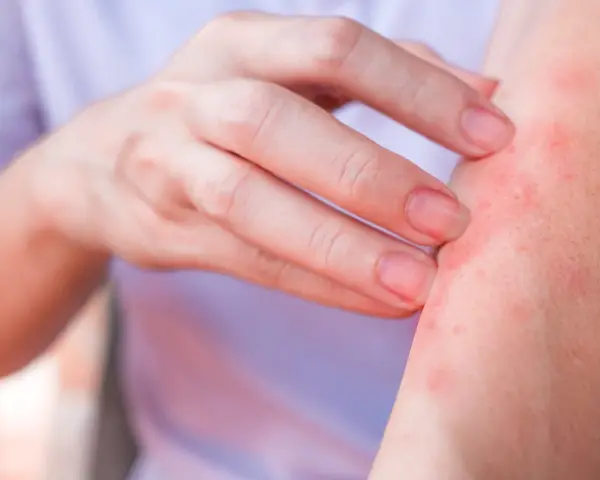 Dito, un braccio con eruzione cutanea rossa e pruriginosa, sintomo di un'allergia al nichel.