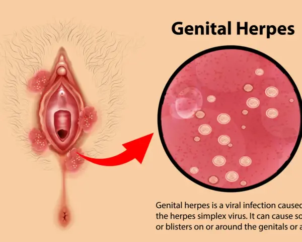 Illustrazione di herpes vaginale con lesioni e ingrandimento del virus.