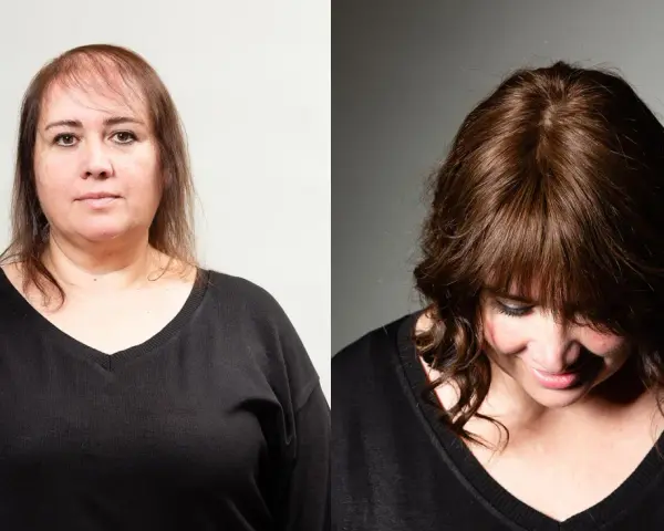 Prima e dopo: capelli diradati davanti, ora più folti e con un taglio che valorizza chi ha pochi capelli.