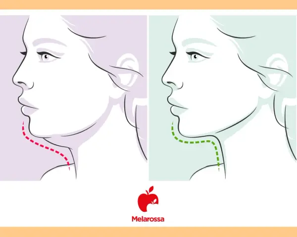 Profilo di donna con doppio mento prima (linea rossa) e dopo (linea verde) un trattamento.