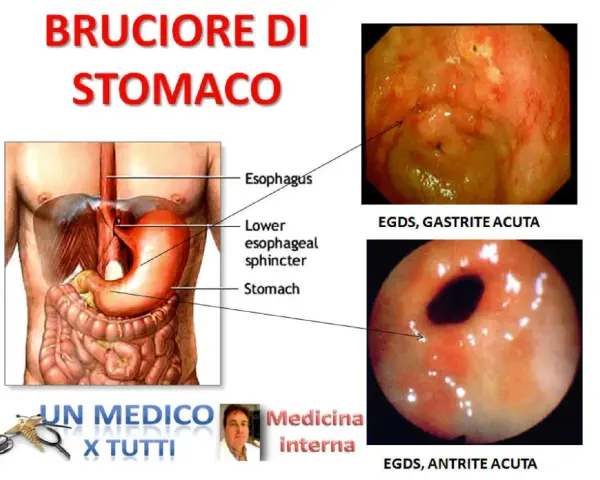 Illustrazione anatomica dello stomaco e immagini endoscopiche di gastrite e antrite acuta, condizioni che causano pirosi gastrica.