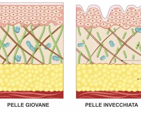 Confronto pelle giovane e invecchiata: la degradazione dell'elastina e del collagene causa rughe.
