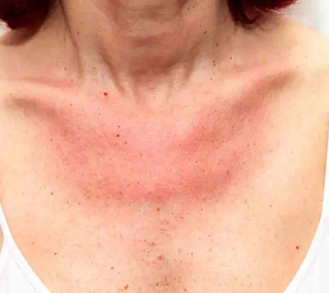 Collo e petto arrossati per eritema solare. Forse i rimedi della nonna possono aiutare a lenire la pelle irritata.