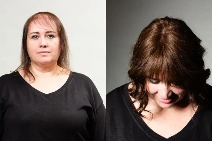 Prima e dopo: capelli diradati davanti, ora più folti e con un taglio che valorizza chi ha pochi capelli.