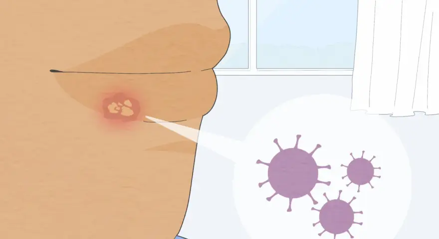 Un primo piano mostra un labbro con un'eruzione cutanea rossa e vesciche, con un ingrandimento che rivela virus. Utile per capire i rimedi per herpes labiale.