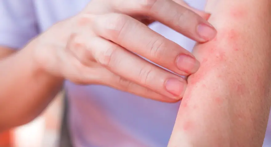 Dito, un braccio con eruzione cutanea rossa e pruriginosa, sintomo di un'allergia al nichel.