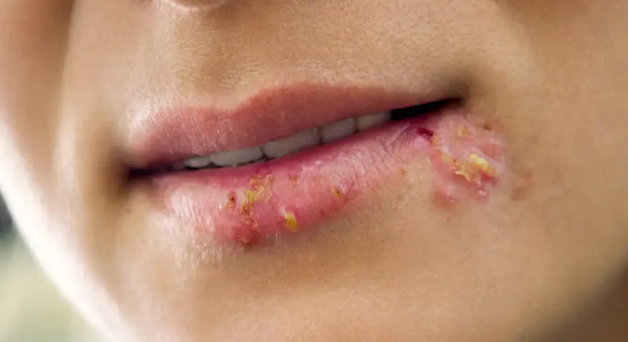 Labbra con vescicole e croste giallastre, tipiche di un herpes labiale. La durata varia, ma spesso si risolve in 1-2 settimane.