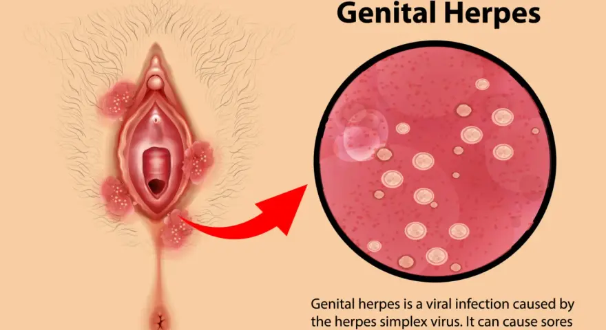 Illustrazione di herpes vaginale con lesioni e ingrandimento del virus.