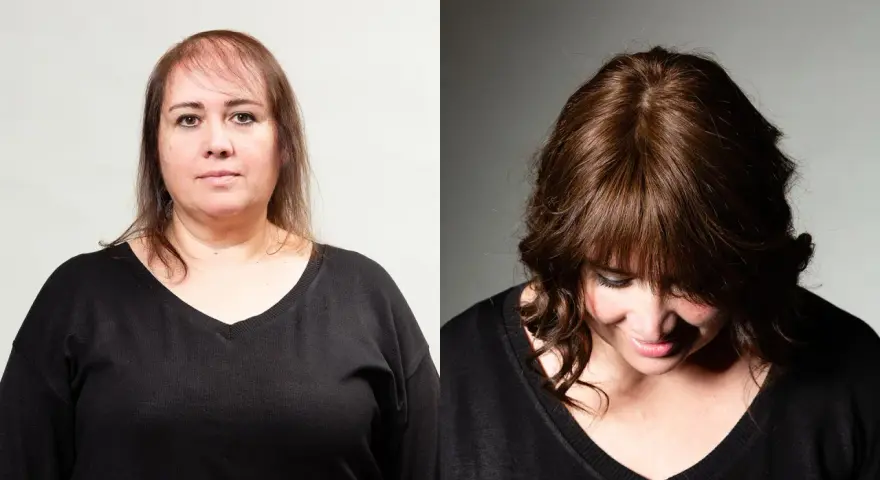 Prima e dopo: capelli diradati davanti, ora più folti e con un taglio che valorizza chi ha pochi capelli.