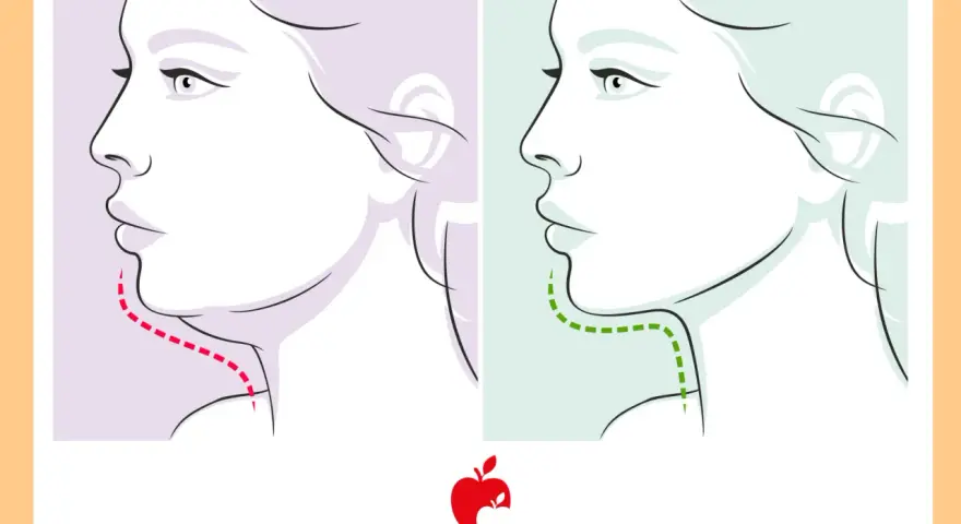 Profilo di donna con doppio mento prima (linea rossa) e dopo (linea verde) un trattamento.