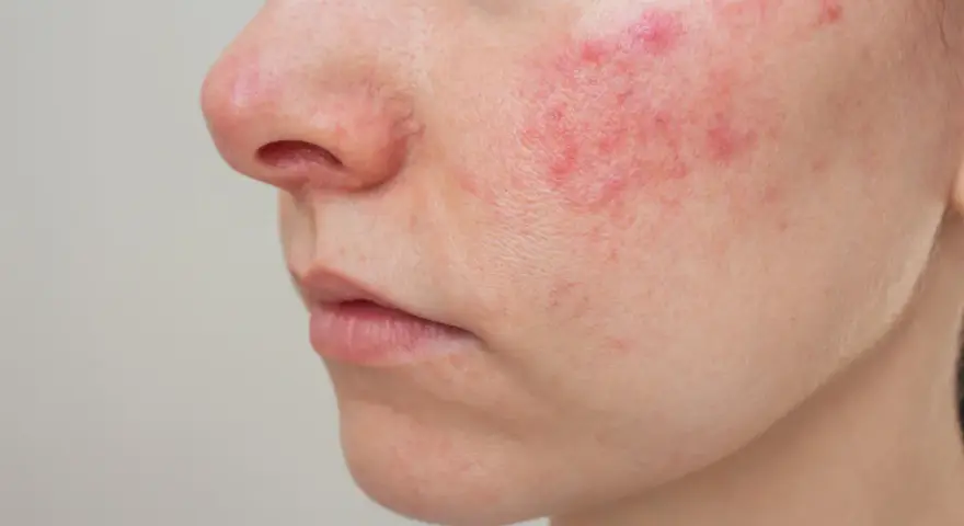 Primo piano del viso con arrossamenti e pustole, possibili effetti collaterali del collagene.