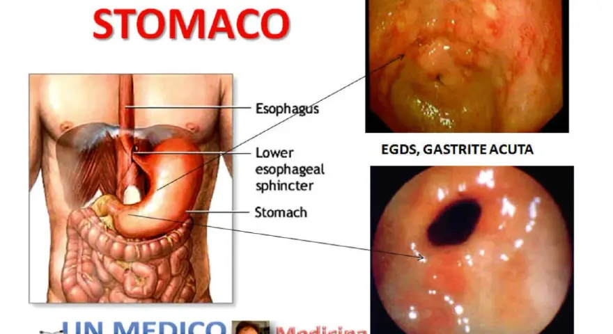 Illustrazione anatomica dello stomaco e immagini endoscopiche di gastrite e antrite acuta, condizioni che causano pirosi gastrica.