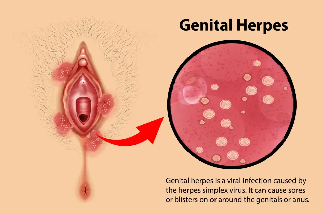 Illustrazione di herpes vaginale con lesioni e ingrandimento del virus.