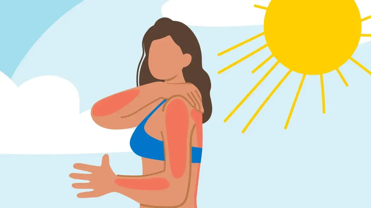 Donna con eritema solare sulle braccia e spalle, sotto il sole. Forse cerca rimedi della nonna per il suo scottatura.