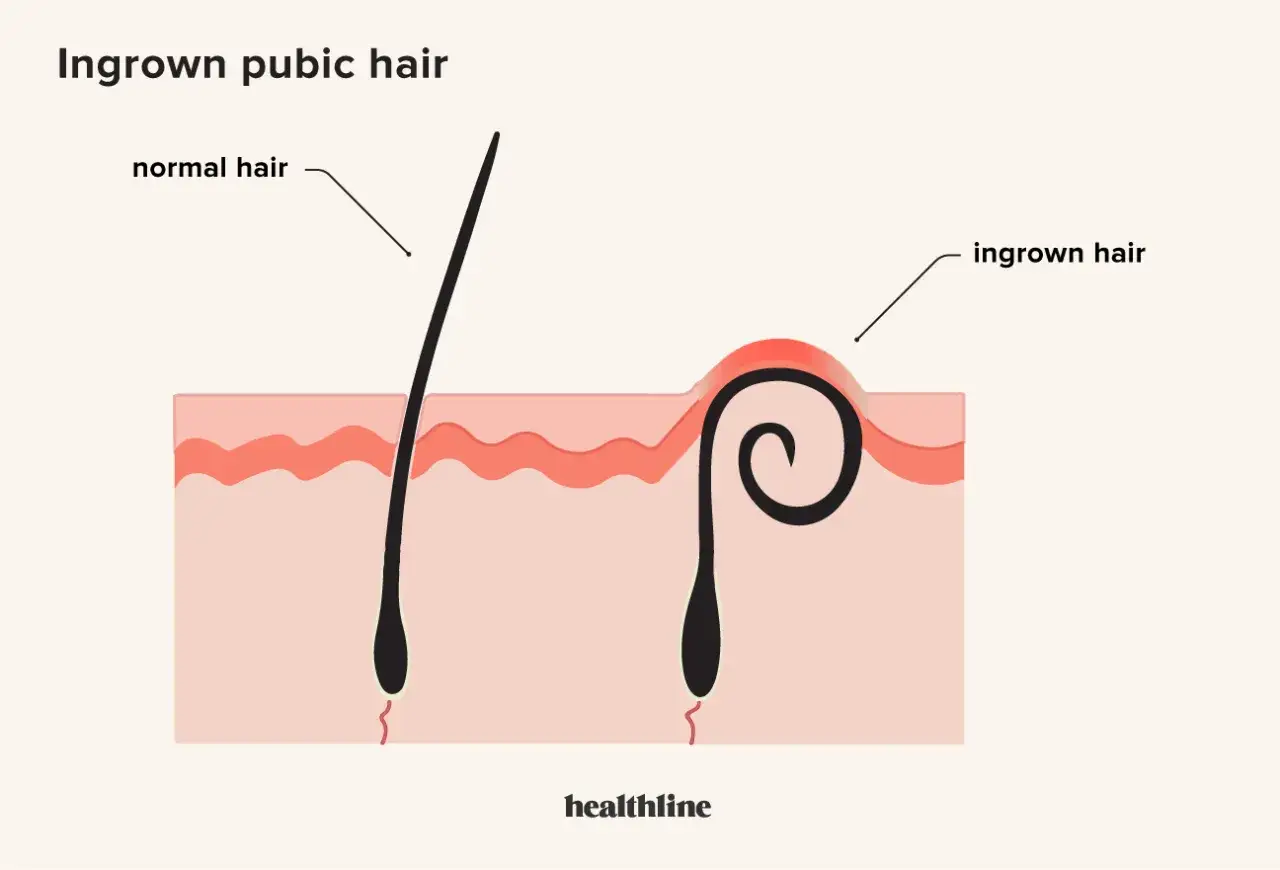 Illustrazione che mostra un pelo normale che cresce fuori dalla pelle e un pelo sottopelle arricciato sotto l'epidermide, causando un'infiammazione.