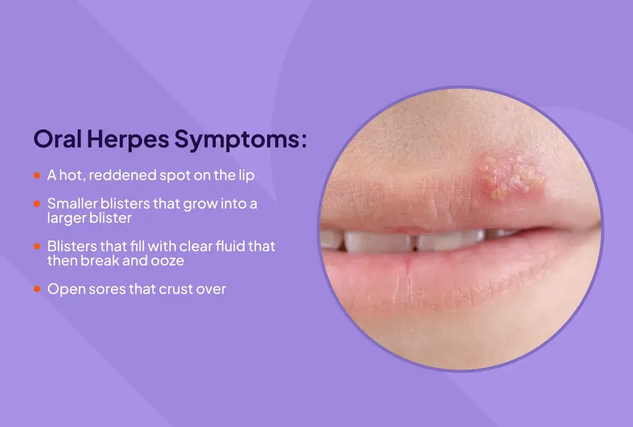 Sintomi dell'herpes labiale: vescicole sul labbro. Scopri i rimedi per l'herpes labiale e come trattare le lesioni.