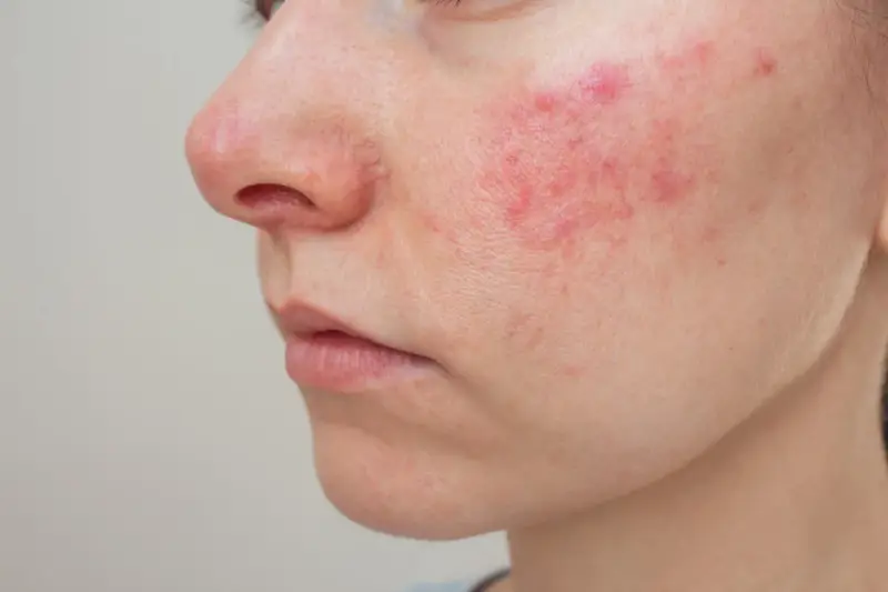 Primo piano del viso con arrossamenti e pustole, possibili effetti collaterali del collagene.